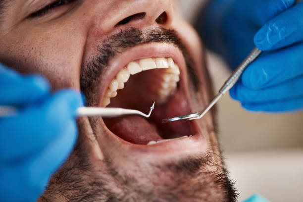 Best Emergency Dentist for Lost Fillings or Crowns in Pendergrass, GA